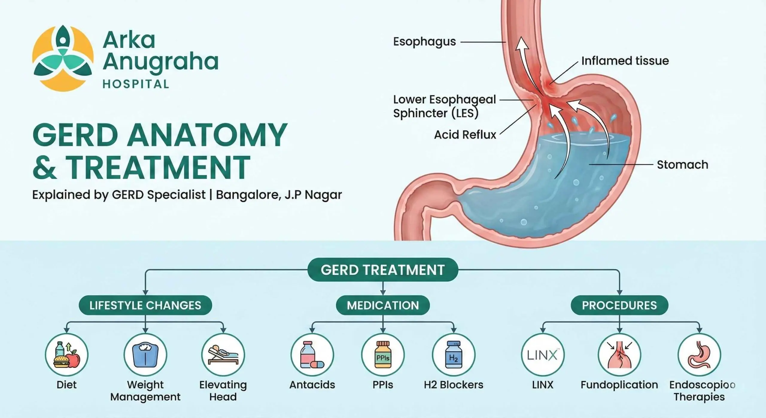 GERD treatment explained by GERD specialist in Bangalore, J.P Nagar