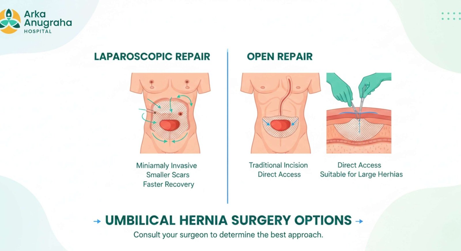 Medical illustration explaining which surgery is best for umbilical hernia