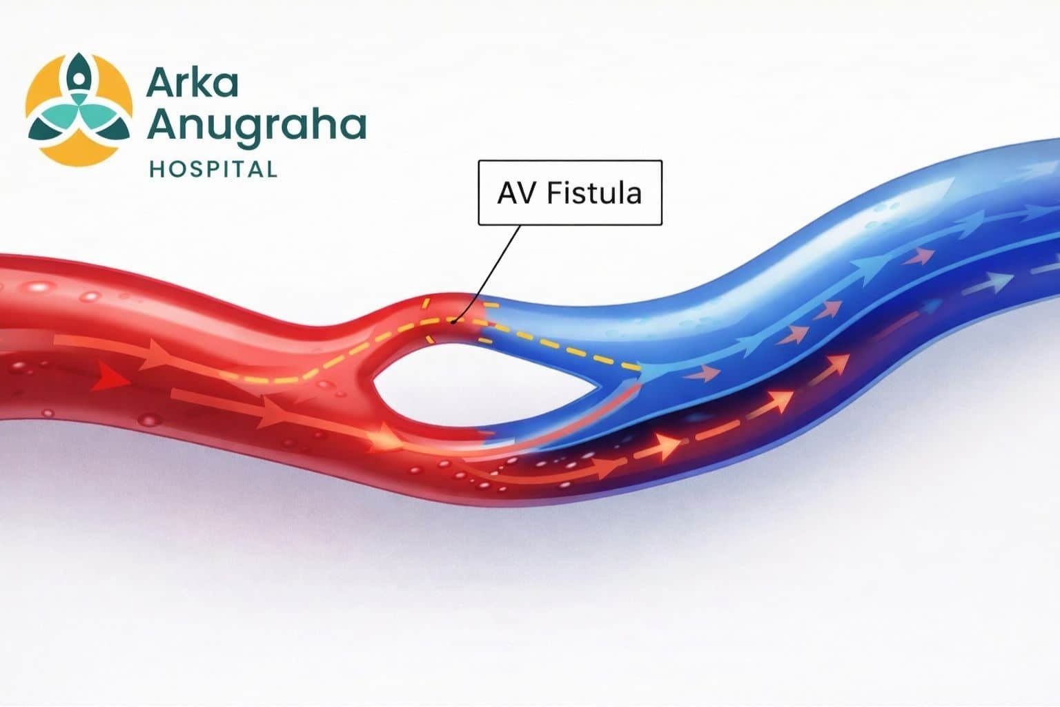 Medical illustration explaining fistula treatment near me in Bangalore