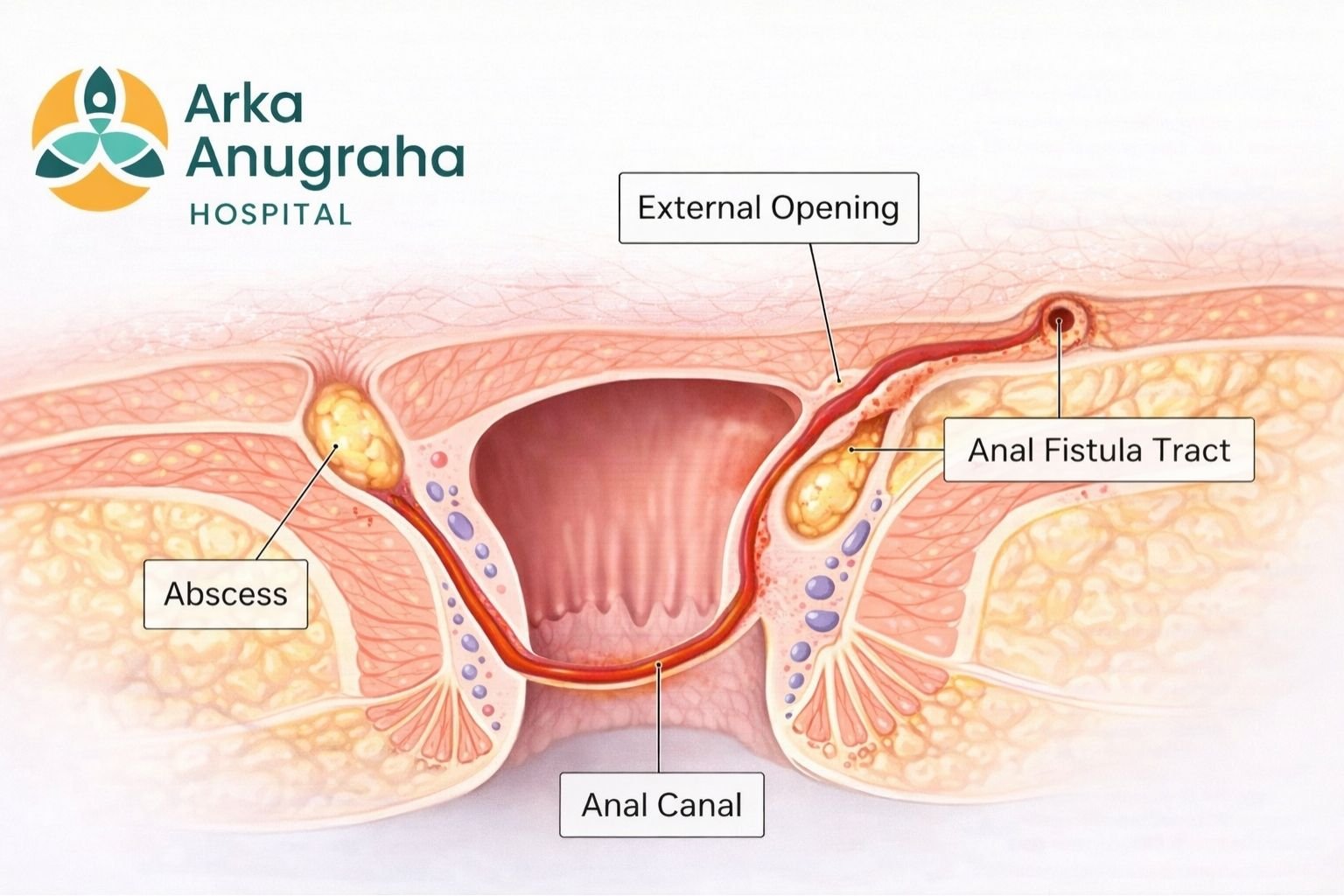 Medical illustration explaining fistula treatment in Bangalore