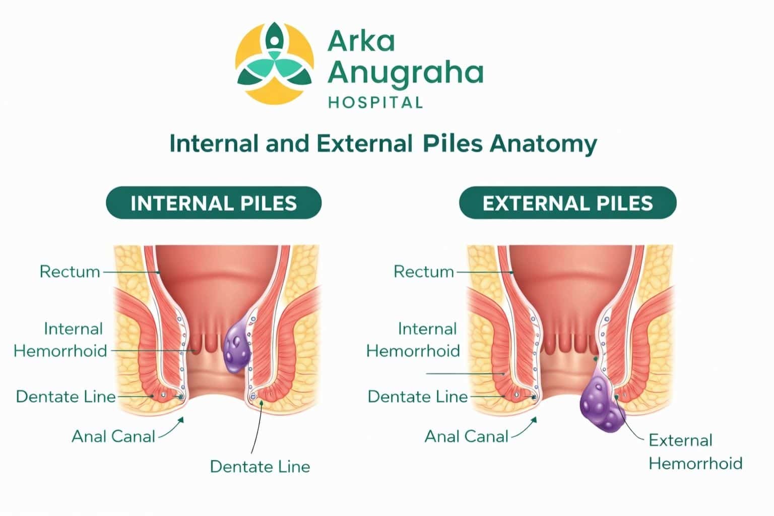 Medical illustration explaining piles surgery in Bangalore