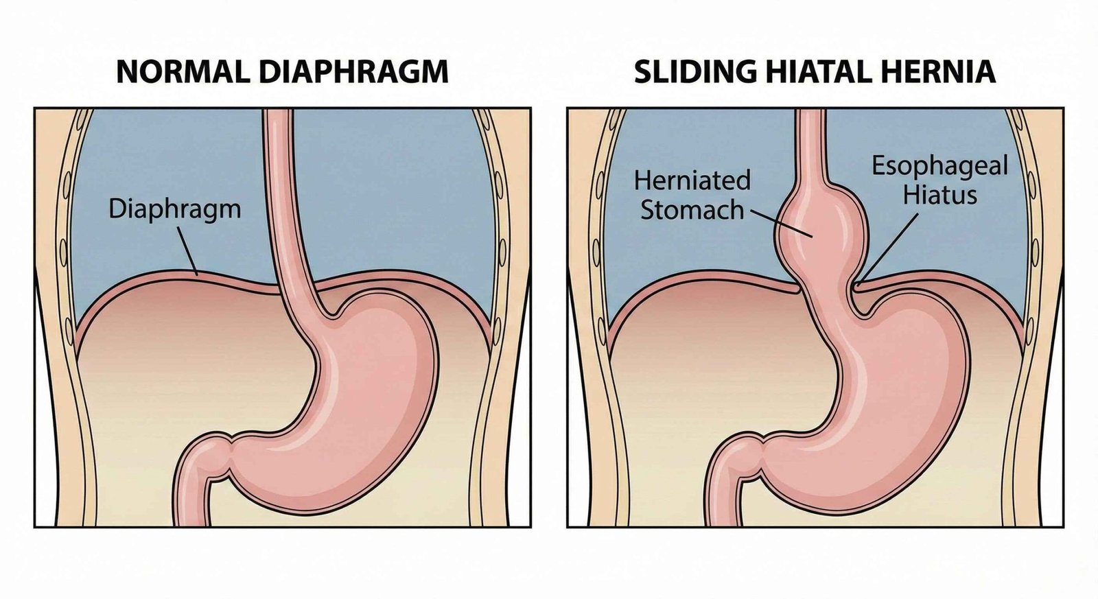 Medical illustration comparing a normal diaphragm vs. a sliding hiatal hernia