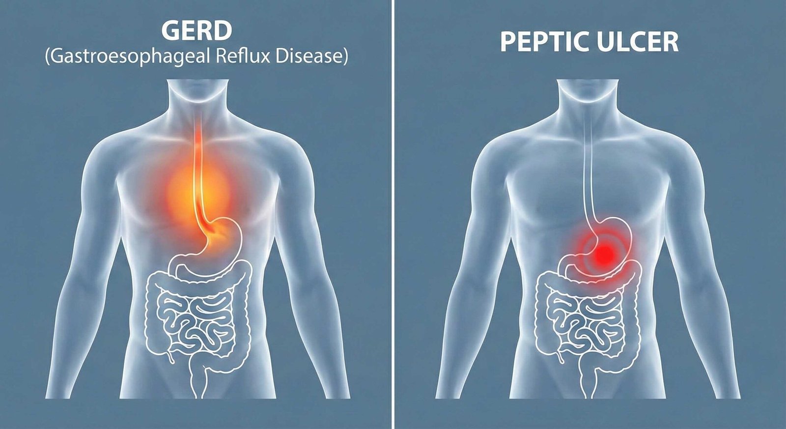 Chest/esophagus highlighted for GERD vs upper abdomen highlighted for ulcer.