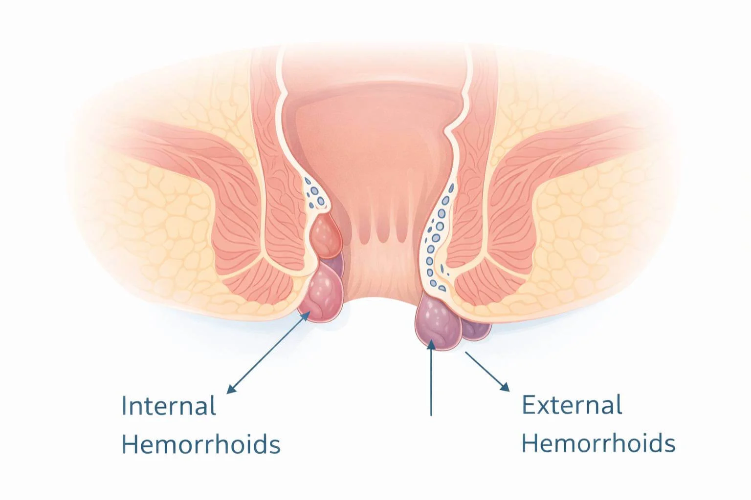 Anatomical diagram showing internal and external hemorrhoids in females