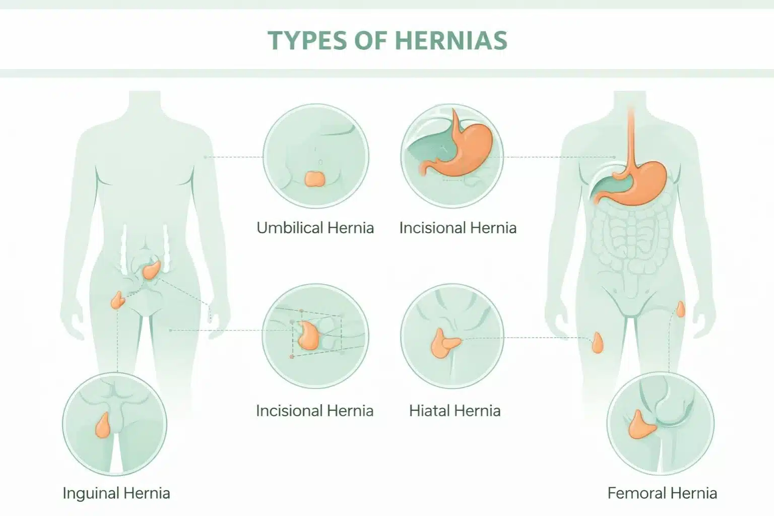 Hernia Operation Cost For Different Types of Hernias