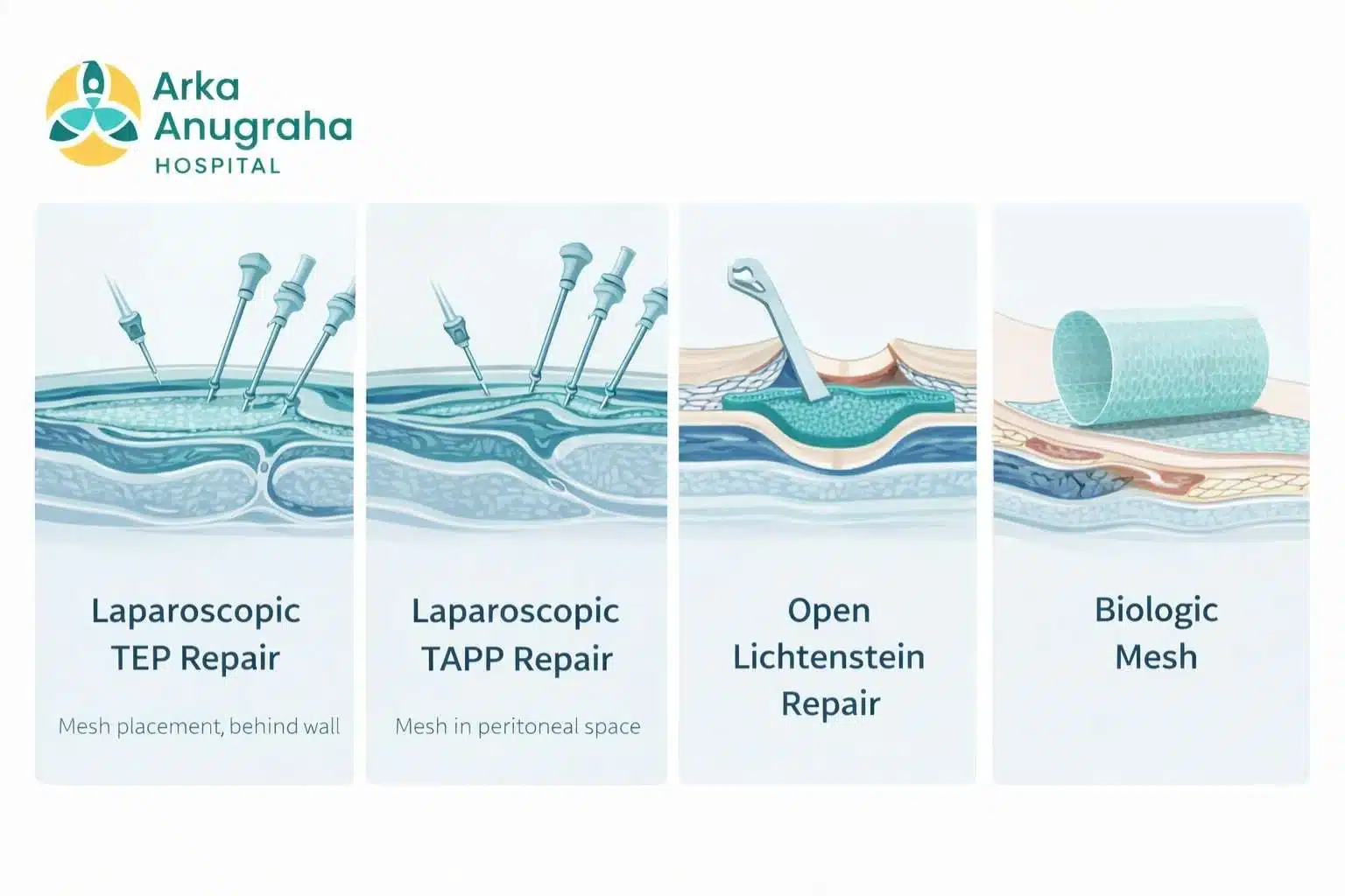 Hernia kit repair techniques comparison — TEP, TAPP, Open and Biological mesh repair