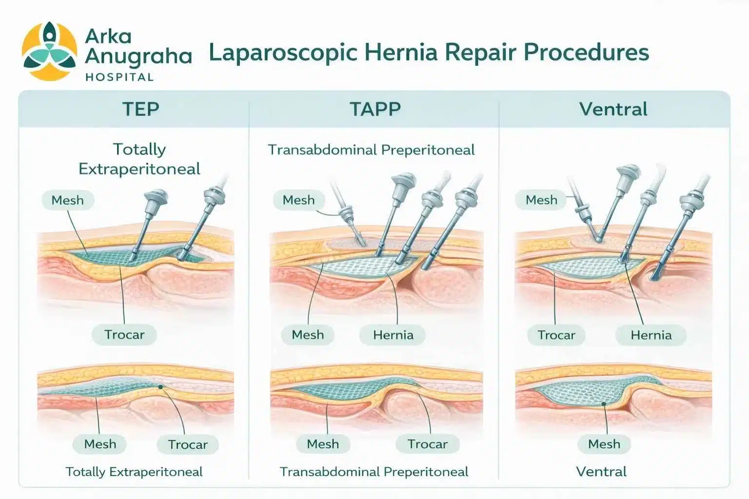 Infographic showing TEP, TAPP, and ventral laparoscopic hernia repair techniques