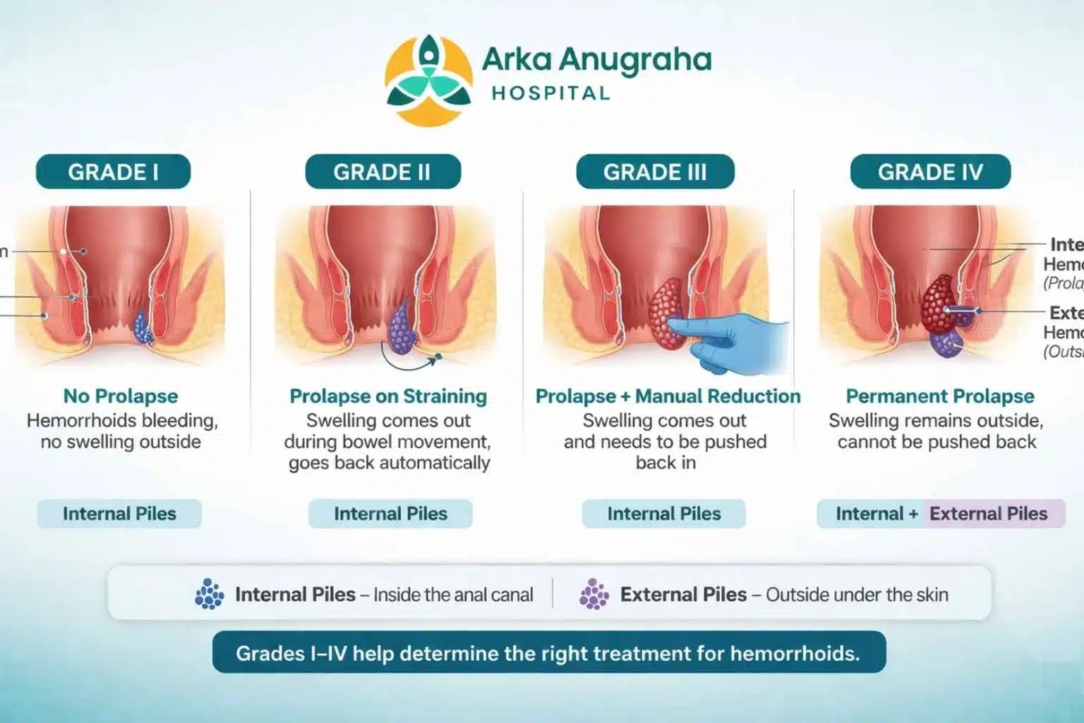 Diagram showing the four grades of piles (hemorrhoids) — Arka Anugraha Hospital, Bangalore